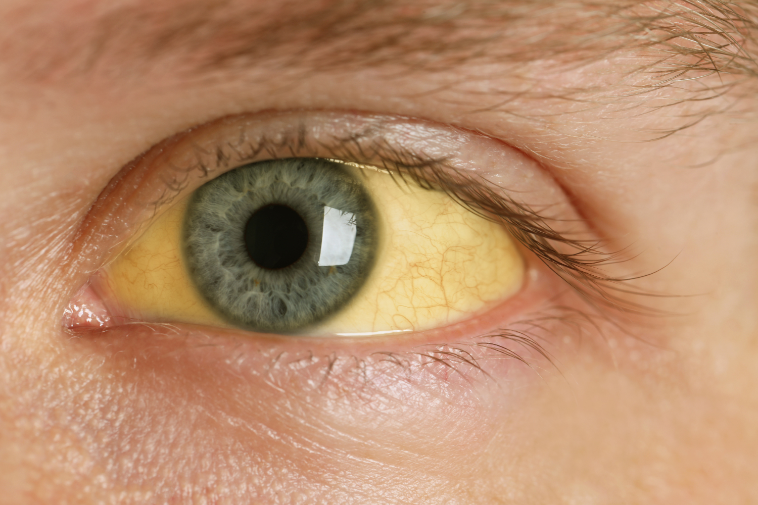 Person with jaundice shown on the eyes.